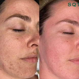 Specialist voert een microneedlingbehandeling uit